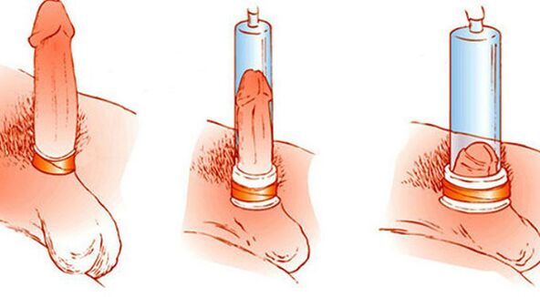 The principle of operation of a vacuum pump that can enlarge the penis